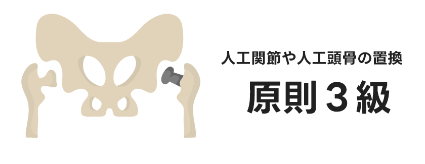 人工関節・人工骨頭での障害年金受給