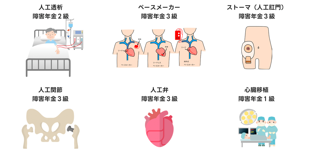 障害年金の等級が決まっている傷病